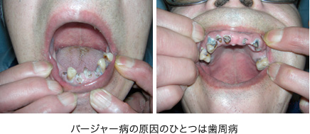 パージャー病の原因のひとつは歯周病