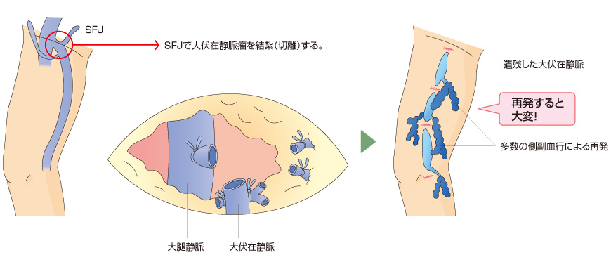 高位結紮術後の再発