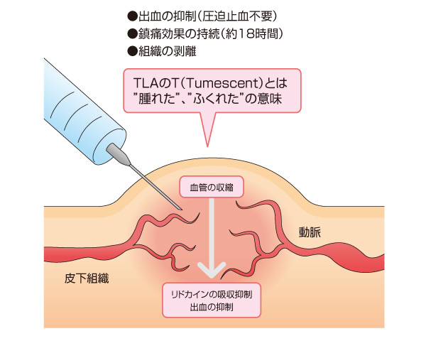 TLA麻酔