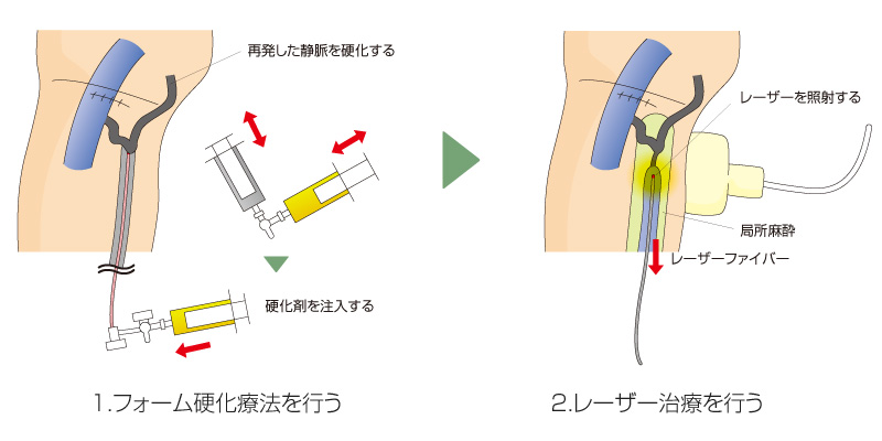 再発静脈瘤に対するレーザー治療