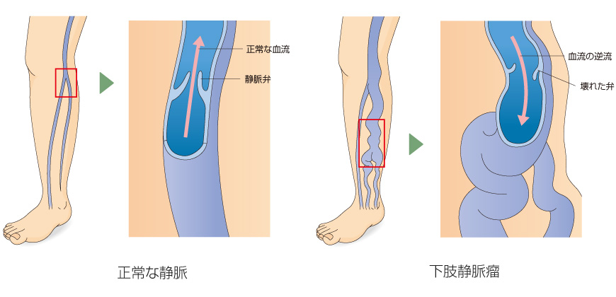 下肢静脈瘤のメカニズム