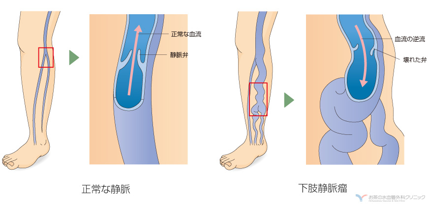 下肢静脈瘤とは お茶の水血管外科クリニック