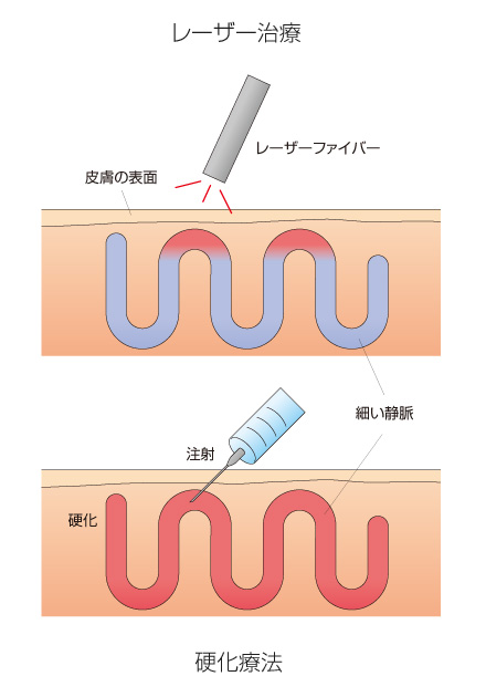 硬化療法 vs レーザー治療