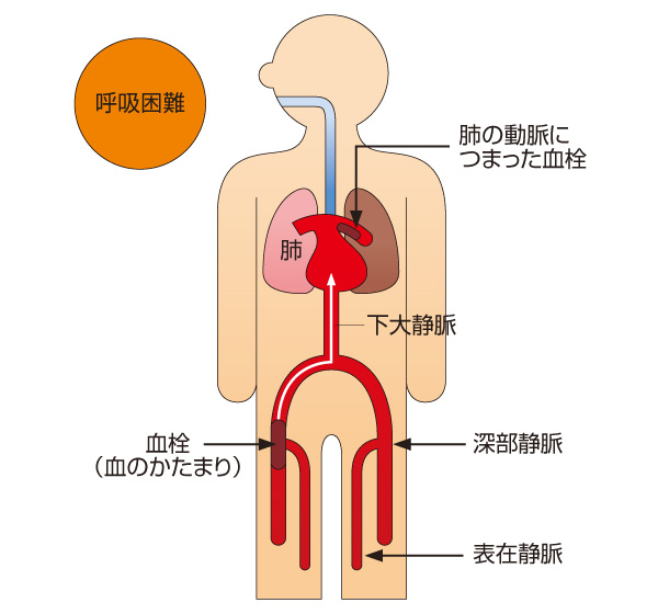 エコノミークラス症候群