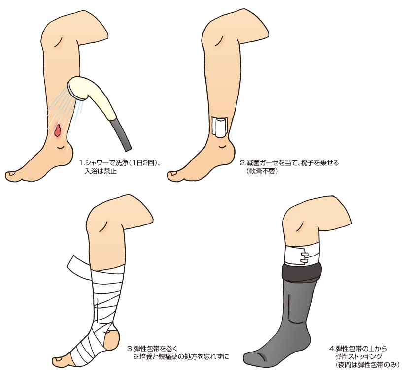 潰瘍の治療