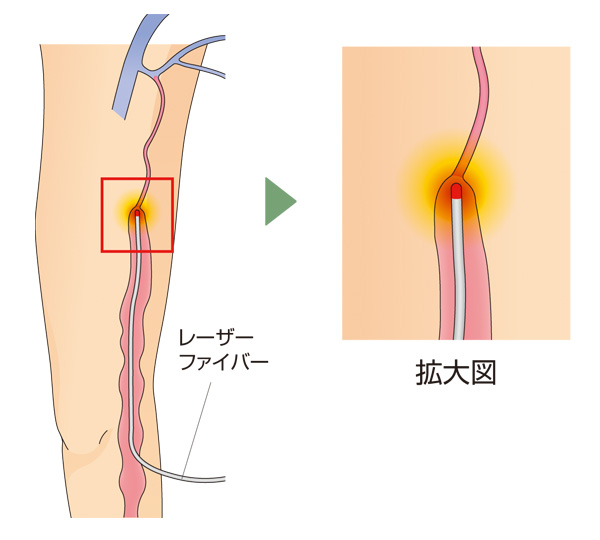 レーザー治療