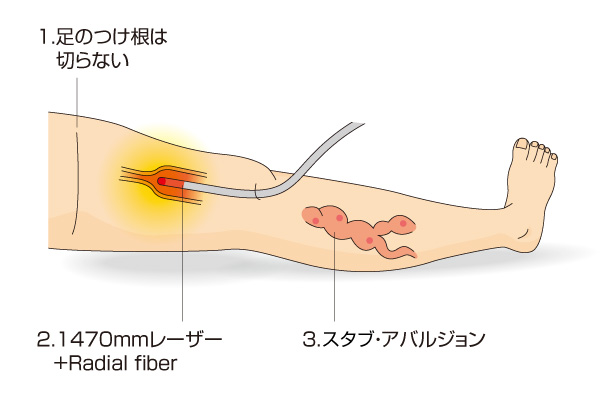 当院のレーザー治療